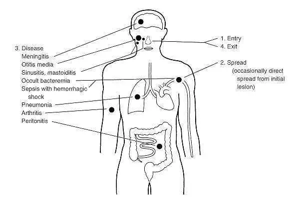 Types of disease caused by Streptococcus pneumoniae