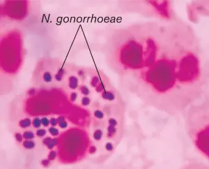 Neisseria gonorrhoeae (Gram negative diplococci)