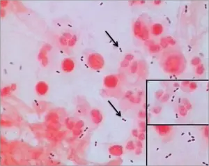 Streptococcus pnuemoniae: Gram positive diplococci