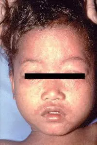 Child infected with Measles Source:: CDC