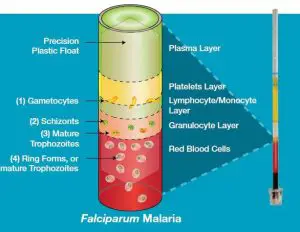 Falciparum malaria in QBC Test