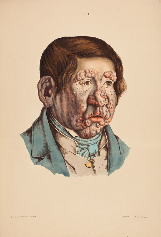 - A man with leprosy (image by J. L. Losting.)