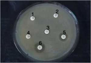  - Antibiotic Sensitivity test: Multidrug-resistantE. colionMueller Hinton Agarisolated from urine sample (1=Amoxycillin, 2=Norfloxacin, 3=Ciprofloxacin, 4=Cefixime, 5=Gentamicin, 6=Nitrofurantoin). No clear zone (and very small clear zone) was seen around different antibiotic discs; this means the bacterial cells are not inhibited by multiple antibiotics.
