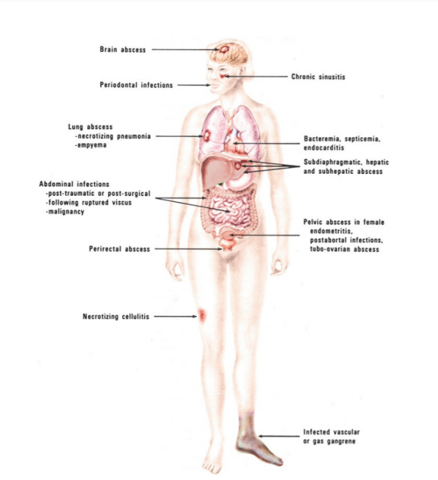  - Common locations of infections involving anaerobic bacteria(Image source: Koneman, Ref-1)