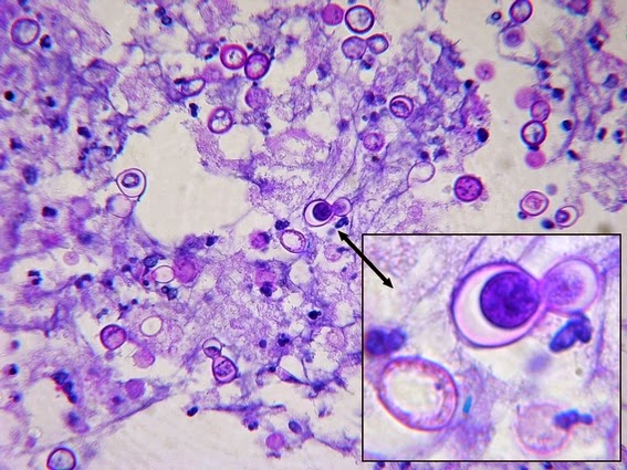  - Blastomyces dermatitidisin Lung Fine Needle Aspiration Assay stained with PAS.The insert shows large broad-based budding as a daughter cell is being produced.(Image source:http://thunderhouse4-yuri.blogspot.com/)
