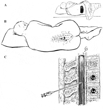 CSF Collection by Lumbar Puncture - Collection of cerebrospinal fluid (CSF) by lumbar puncture