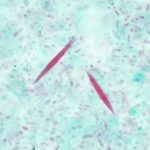 Charcot Leyden Crystals - Charcot Leyden Crystals