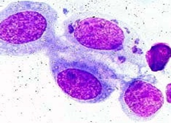  - Giemsa Staining Photograph showing epithelial cells of conjunctiva containing intra-cytoplasmic inclusions “draped” around nucleus (source)
