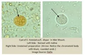 Wet Mount Smear of Stool showing E. histolytica