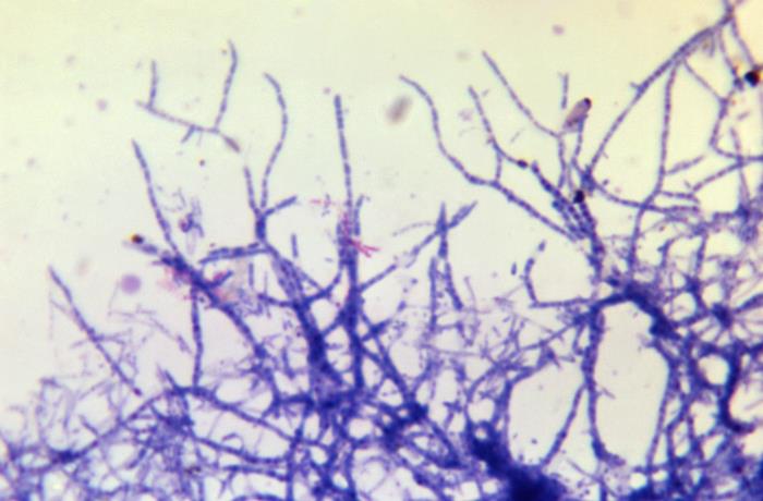 Filamentous Nocardia spp. in Kinyoun acid fast stain  - Filamentous Nocardia spp. in Kinyoun acid fast stain(Image source; CDC/Phil Health)