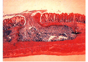 Flask Shaped Ulcer - Flask Shaped Ulcer (Histopathology, UFPA, Araujo R.)