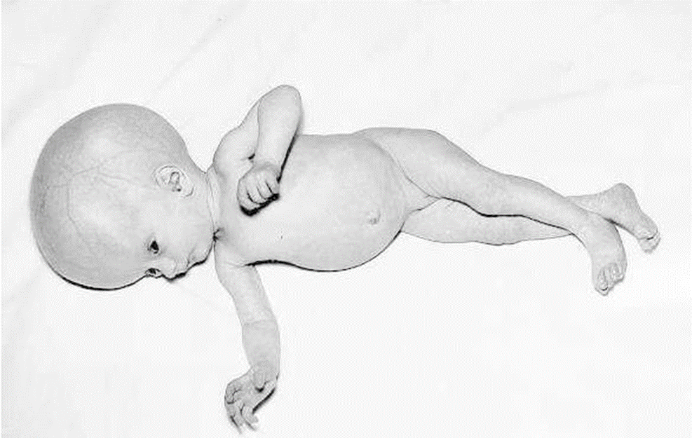 A girl with hydrocephalus due to congenital Toxoplasma infection - A girl with hydrocephalus due to congenital Toxoplasma infection