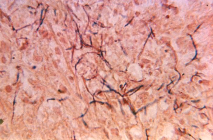 Nocardia spp in tissue section stained using the Brown & Brenn method - Nocardiaspp in tissue section stained using the Brown & Brenn method(Image source: CD/Phil Health)