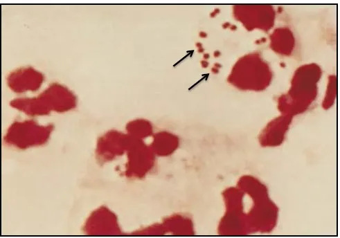 Gram stain of N. meningitidis in CSF with associated PMNs - Gram stain of N. meningitidis in CSF with associated PMNs