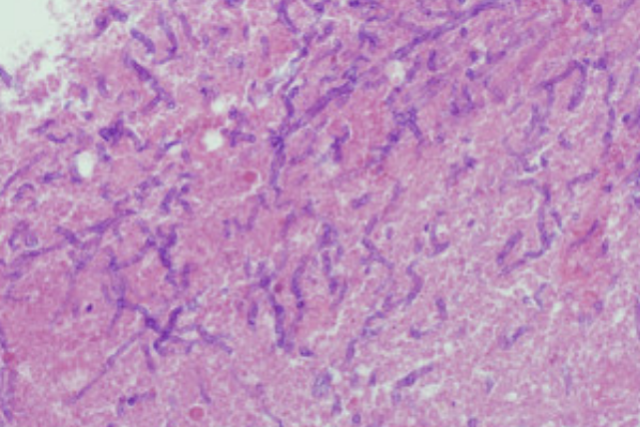 Haematoxylin and Eosin stain - Hematoxylin and Eosin stain showingAspergillusspp.Image source: DOI:10.1002/lary.25429