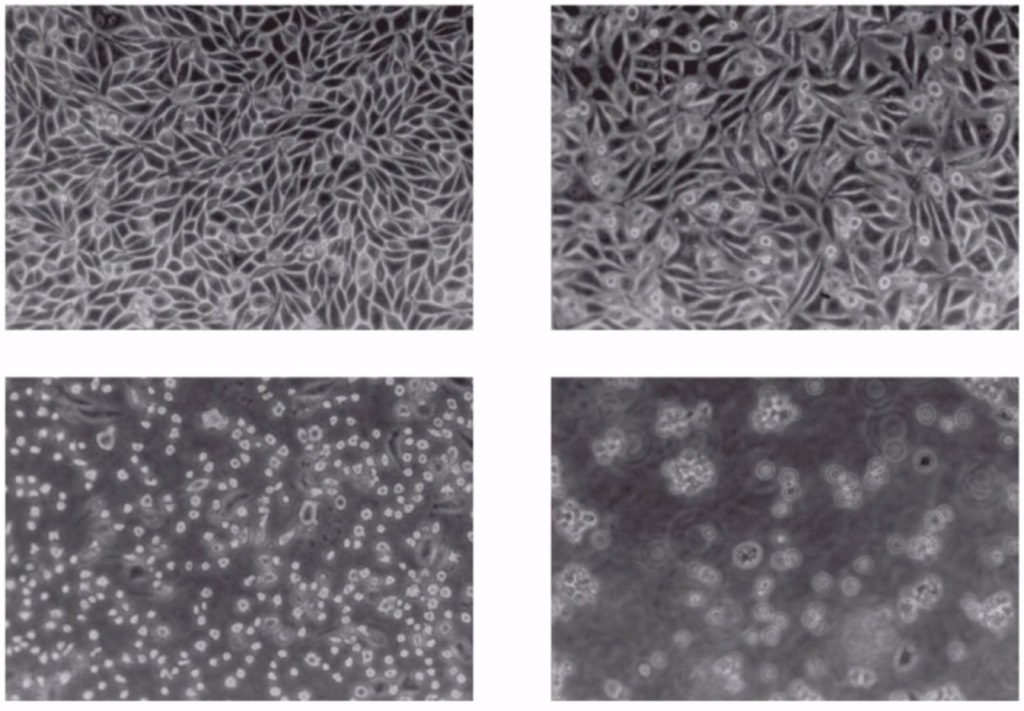 HeLa cell lines infected with poliovirus - HeLa cell lines infected with poliovirus(From top left, normal cells, 4 hours, 8 hours and 12 hours after infections)