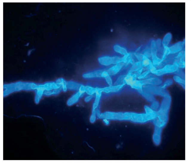 Direct microscopic examination of organisms causing mucormycosis - Direct microscopic examination. CT guided percutaneous lung biopsy stained with Fungi-Fluor shows typically distorted, non-septate and broad hyphae. (Imagesource)