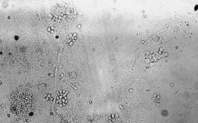 KOH wet mount (fungal staining technique) - Yeast and hyphae on KOH wet mountImage source:Frederick