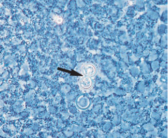  - Potassium hydroxide preparation examined in phase-contrast microscopy showed a large budding yeast cell with a distinct broad base bud(Blatomyces dermatitidis)