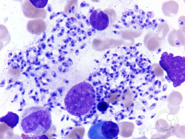 LD Bodies detection for Kala-azar diagnosis  - Heavy LD body infestation in bone marrow aspirate. (Imagesource)