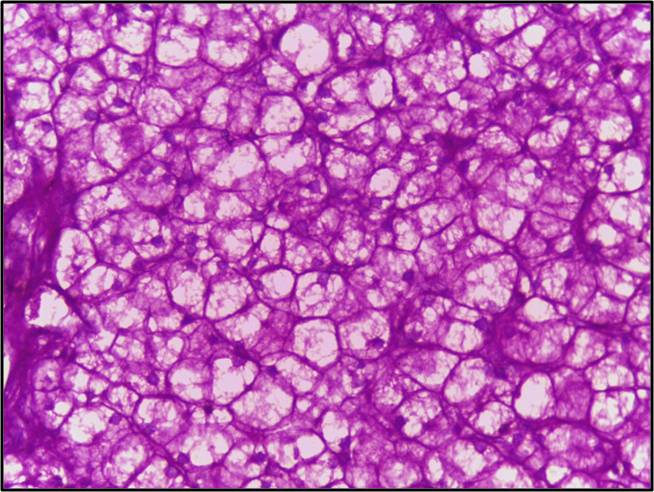 - Liver biopsy of glycogen storage disorder PAS positive
