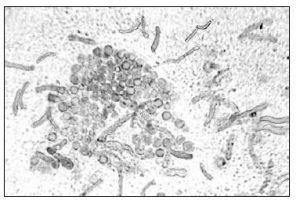 Malassezia furfur yeast cells and hyphae in KOH blue–black ink preparation. - Image 2:Malassezia furfuryeast cells and hyphae in KOH blue–black ink preparation.(Image source: Reference 1)