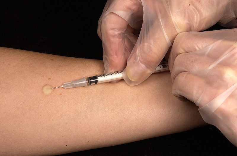 Mantoux tuberculin test - Mantoux tuberculin test(Image source: CDC/PHIL)