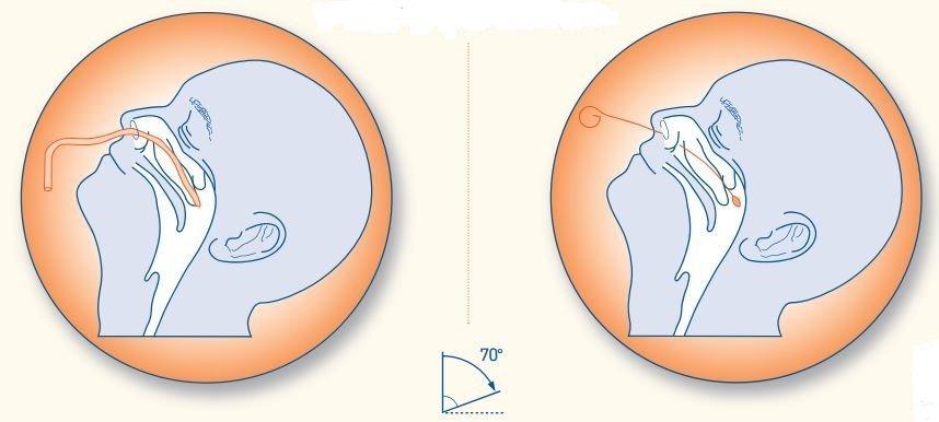 Procedure for Nasopharyngeal aspirate and Swab - Procedure for Nasopharyngeal aspirate and Swab