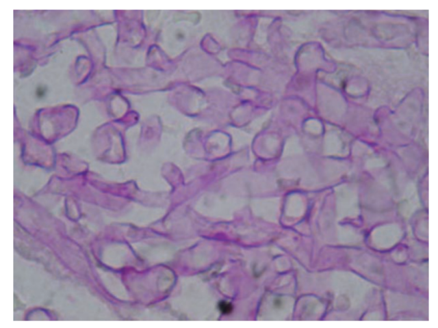 Periodic acid-Schiff staining of organisms causing mucormycosis - Periodic acid-Schiff staining of CT-guidedpercutaneous lung biopsy shows broad-based, ribbon-like, non-septate hyphae with right-angle branching and swollen cells. (Imagesource)