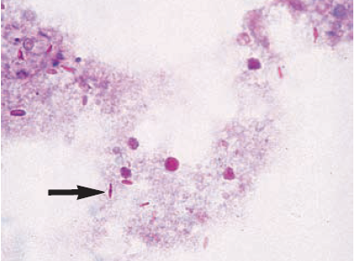 PAS staining of exudate shows the cigar to oval shaped yeast cells (arrow) of Sporothrix spp. - PAS exudate staining shows the cigar to oval-shaped yeast cells (arrow) ofSporothrixspp.