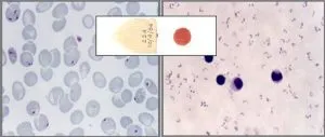 P. falciparum trophozoite stage in thick (right) and thin (left) smear. - P. falciparumtrophozoite stage in thick (right) and thin (left) smear.