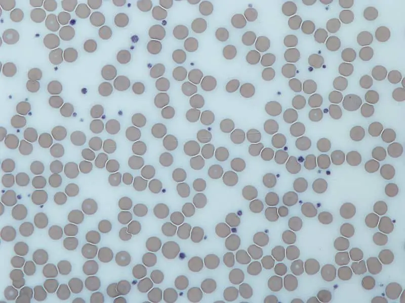 Platelets - Platelets in Giemsa Stained blood film