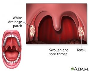 Streptococcal sore throat (Strep throat) features.  - Streptococcal sore throat (Strep throat) features.