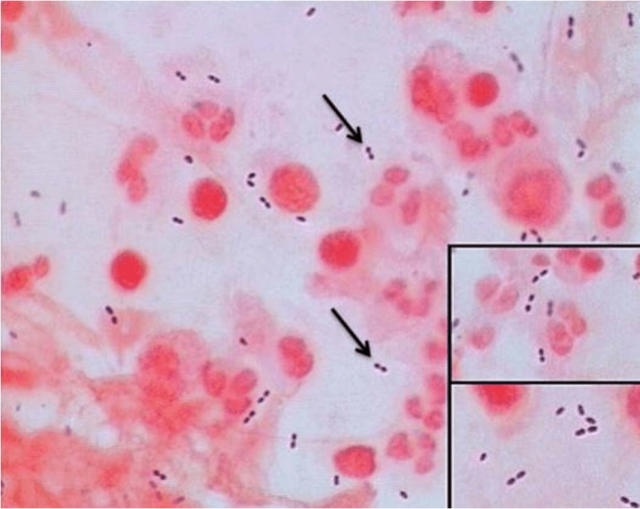 Streptococcus pneumoniae in Gram Stain - Streptococcus pnuemoniae: Gram positive diplococci