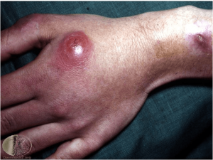  Swimming pool granuloma caused by Mycobacterium marinum - Swimming pool granuloma caused byMycobacterium marinum