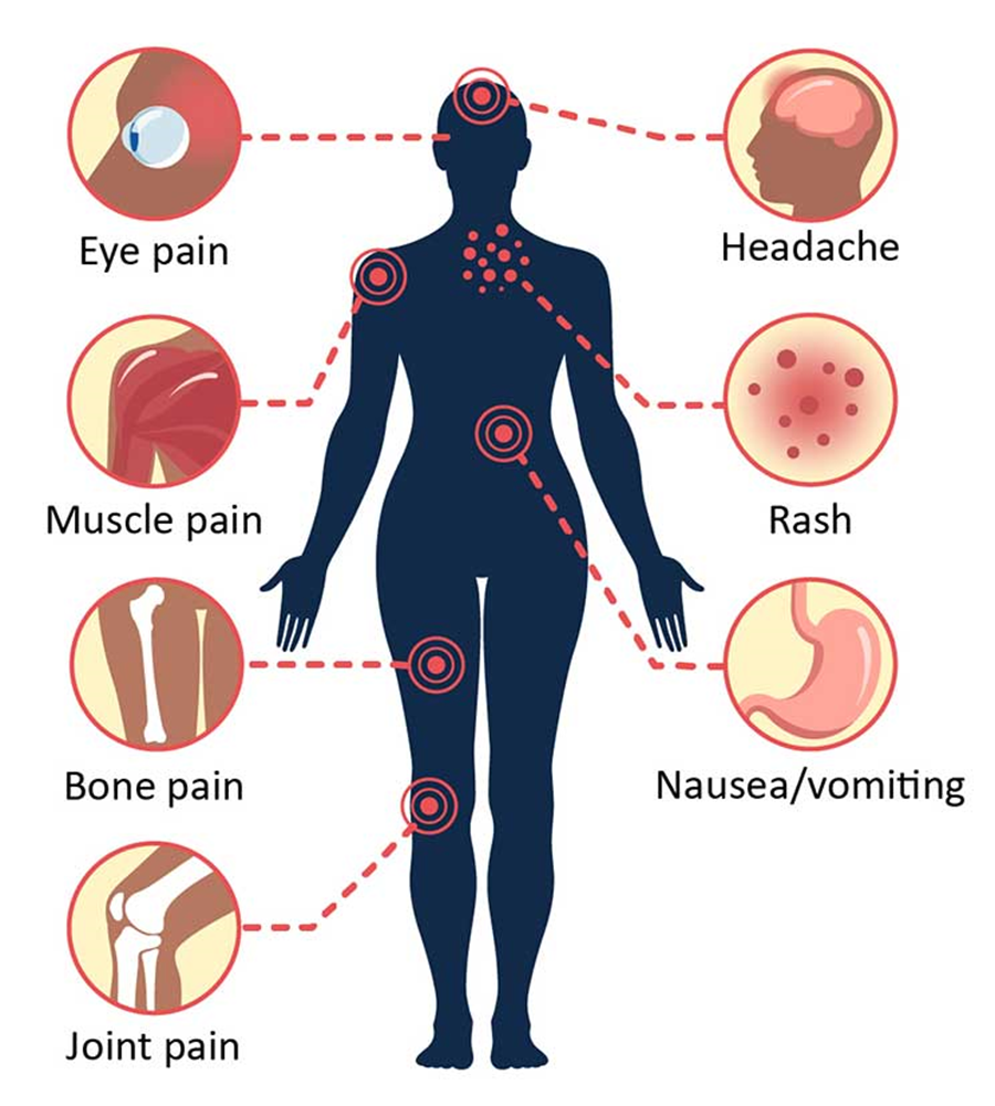 Symptoms of Dengue viral infection  - Symptoms of dengue viral infection