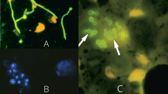 calcofluor white stain - A. Calcofluor white stain of urine demonstratesCandida albicansB.Calcofluor white staining ofPneumocystisorganisms in bronchoalveolar lavage (BAL) specimenC.Calcofluor white stain of sputum showing intracellular yeast cells ofHistoplasma capsulatum(arrows), Image source: Bailey and Scott, DOI:10.1177/1753465810380102