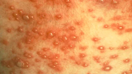  - Vesicular rashes in chickenpox (Image source: CDC/PHIL)Three types of lesions are most often seen in varicella-zoster infections;maculopapular lesions (lesions with a raised red bump), vesicular lesions (blister-like or fluid-filled lesions), and scabbed or crusted lesions.