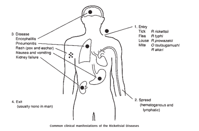  - Common Clinical Manifestations of Rickettsial Diseases