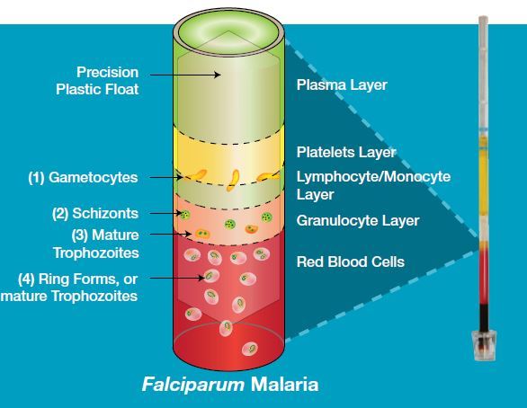 Quantitative Buffy Coat - Falciparum malaria in QBC Test