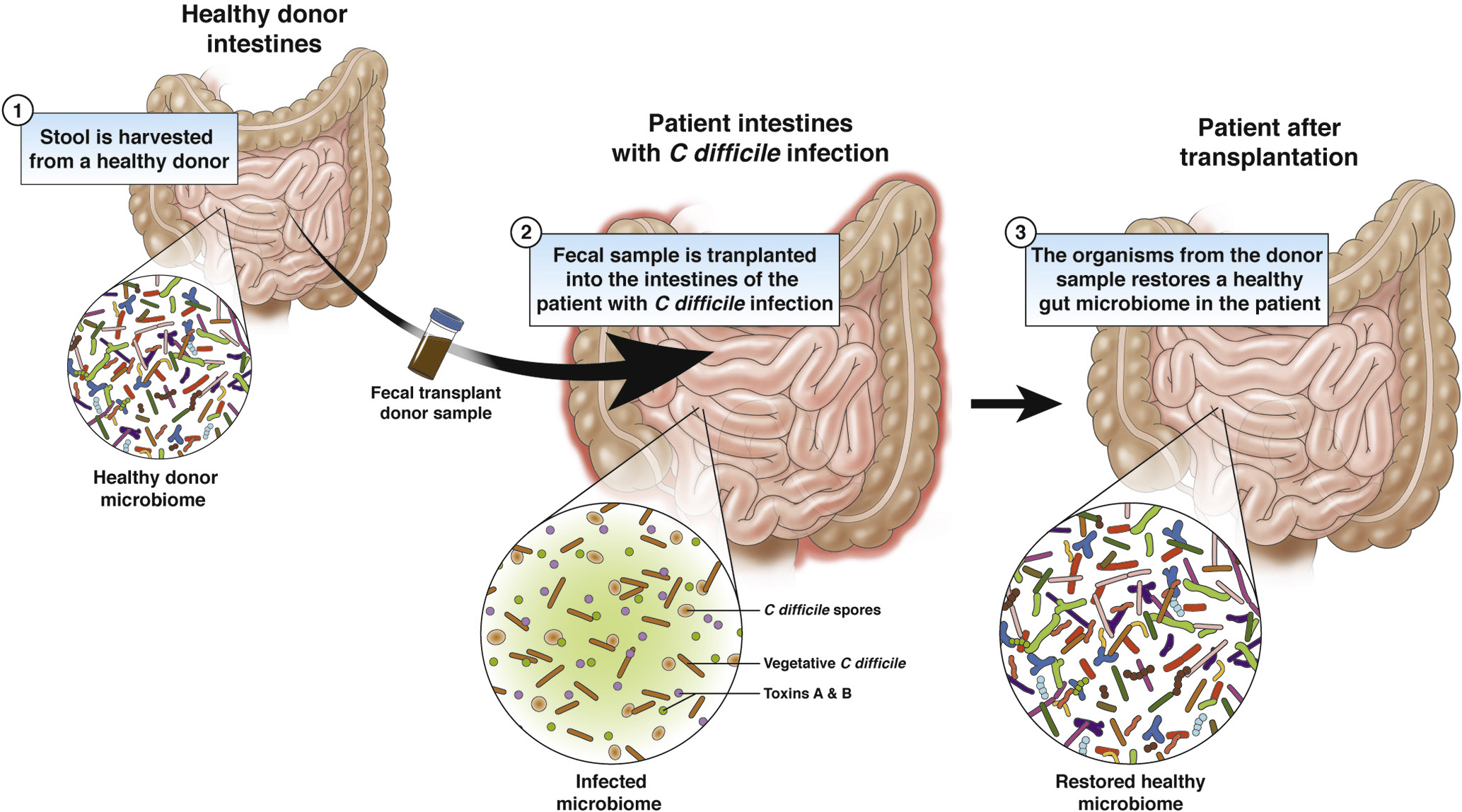 Fecal Transplant