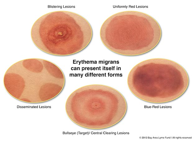 Erythema migrans can present itself in many different forms. - Different types of rash are seen in Lyme disease. Not everyone will have a “bullseye”  rash.(Imagesource)
