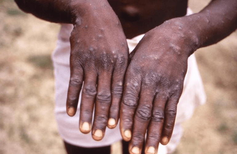 Lesions of monkeypox - Monkeypox ( Source: CDC)