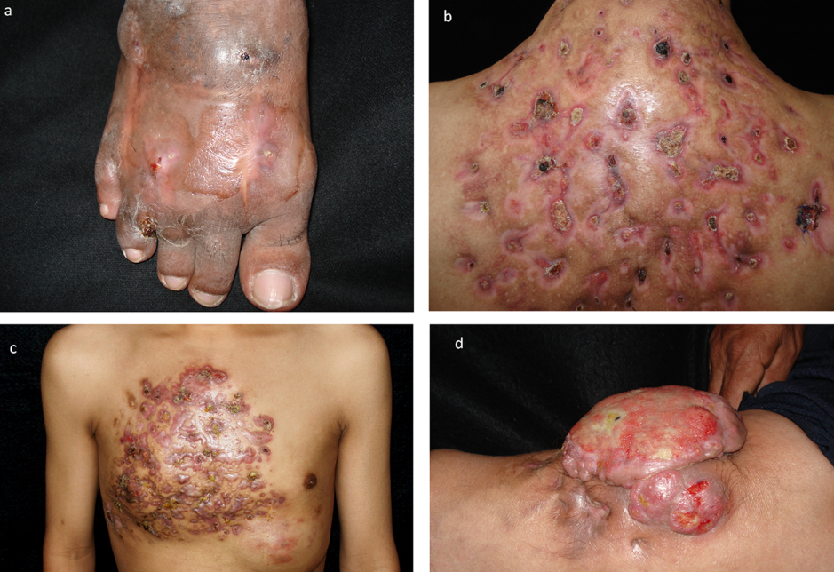 mycetoma - Image source : DOI:https://doi.org/10.1371/journal.pntd.0003102.g003a)A. maduraecausing foot mycetomab) N. brasiliensiscausing back mycetoma with multiple sinusesc)N. brasiliensiscausing extensive mycetomad)Fusarium solanicomplex causing tumoral mycetoma