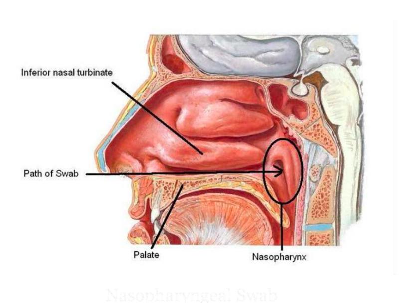 Nasopharyngeal swab - Nasopharyngeal swab