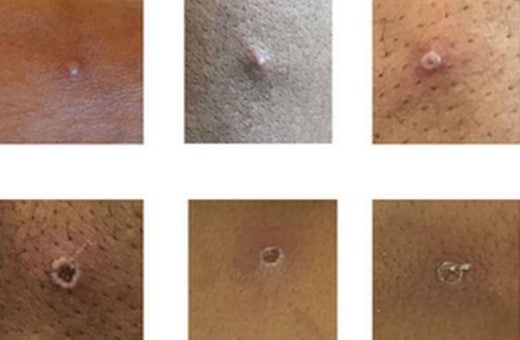 progression of lesions - Skin lesions of monkeypox Source:https://www.gov.uk/