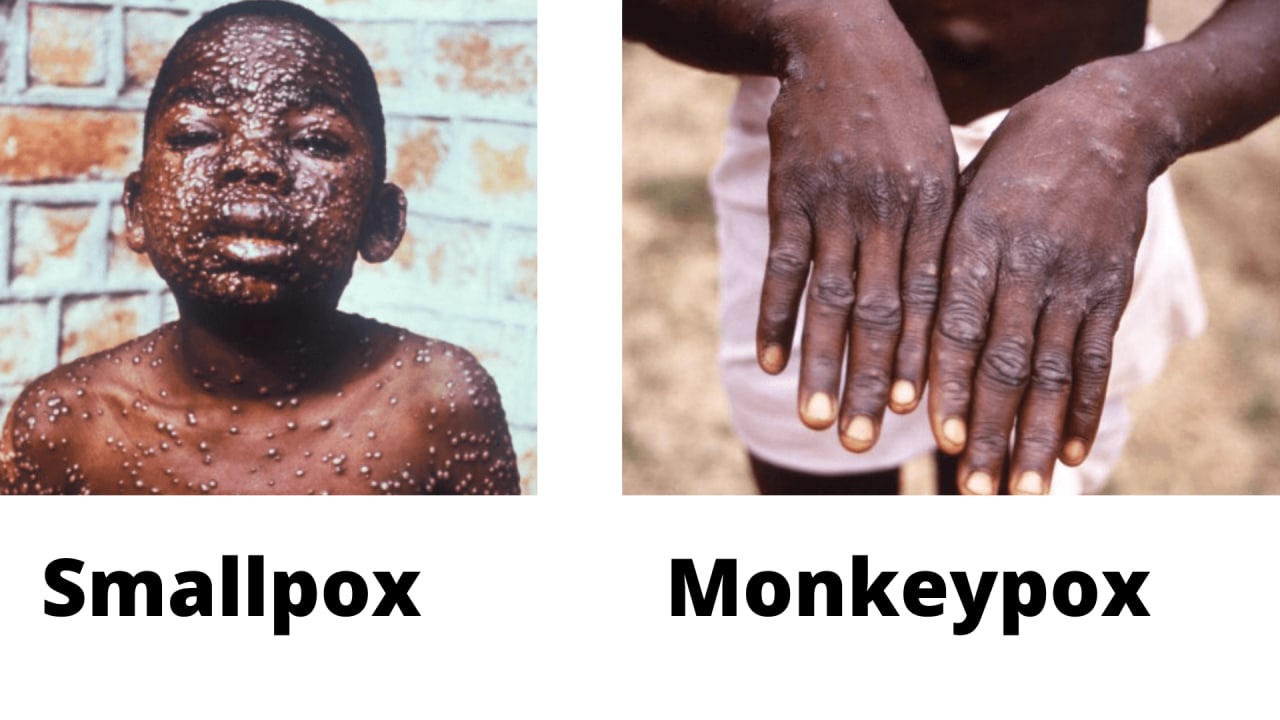 difference between smallpox and monkeypox - Source: CDC
