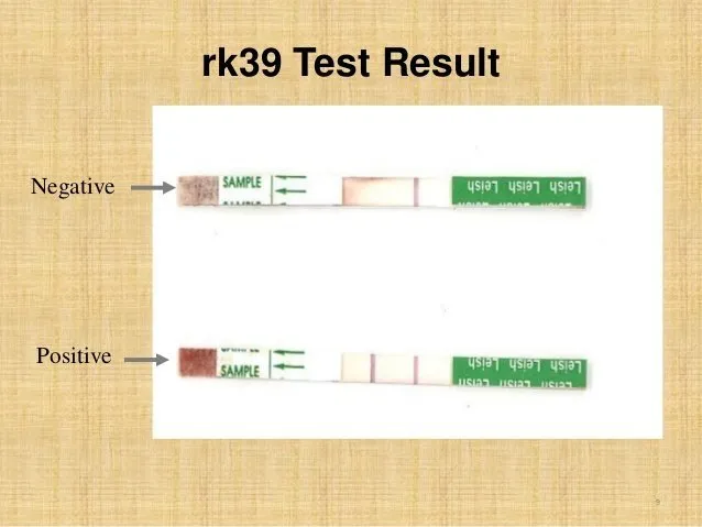 rK39 test for Kala Azar Diagnosis - rK 39 test result for visceral leishmaniasis