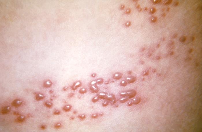 Shingles rash - Shingles rash (Image source: CDC/PHIL)