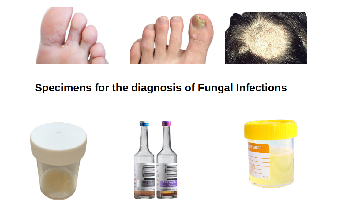 Specimen for fungal diagnosis - Clinical Specimens for the diagnosis of fungal infections
